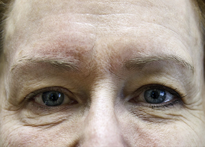 Exilis_PIC_261-Before-eyes-female-Hartsough_412x296px_1589889295_original