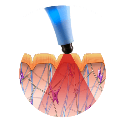 Áreas de Aplicación Exilis es un tratamiento "de la cabeza a los pies". Sus aplicadores especializados permiten trabajar: • Facial: Rostro completo, óvalo facial (efecto lifting), papada, bolsas de los ojos y arrugas periorbiculares (patas de gallo), cuello. • Corporal: Abdomen, flancos, brazos, muslos, glúteos y rodillas.