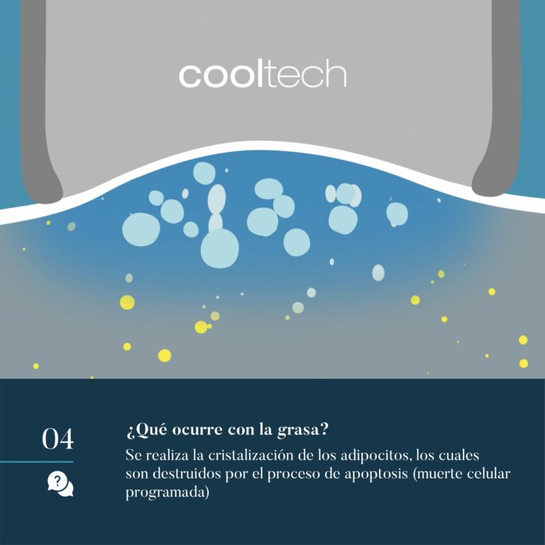 Preguntas Cooltech Criolipólisis para moldeamiento