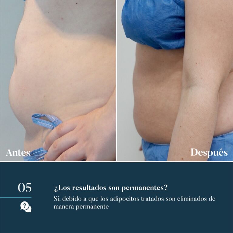 Preguntas Cooltech Criolipólisis para moldeamiento