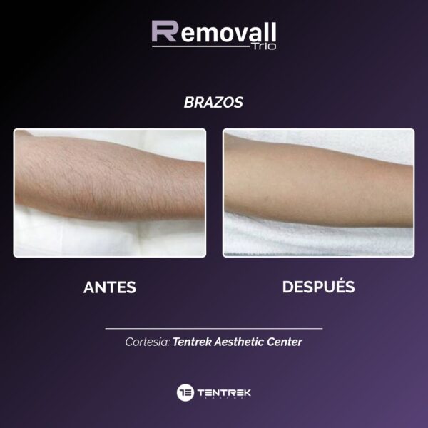 ratamientos todo el día con Dual Cooling Engines. Removall Trio integra un potente motor de doble refrigeración, los cuales le permiten trabajar hasta 12 horas continuas sin sobrecalentarse.